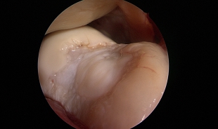 Knorpelschaden Trochlea
