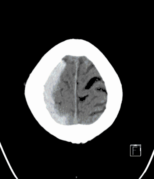 Schaedelhirntrauma Schaedelhirntrauma